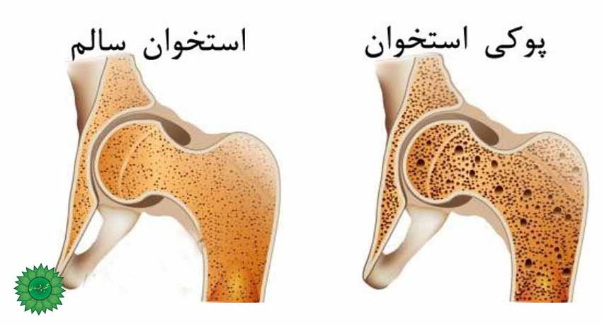 سنجد سفید مفید برای درمان پوکی استخوان