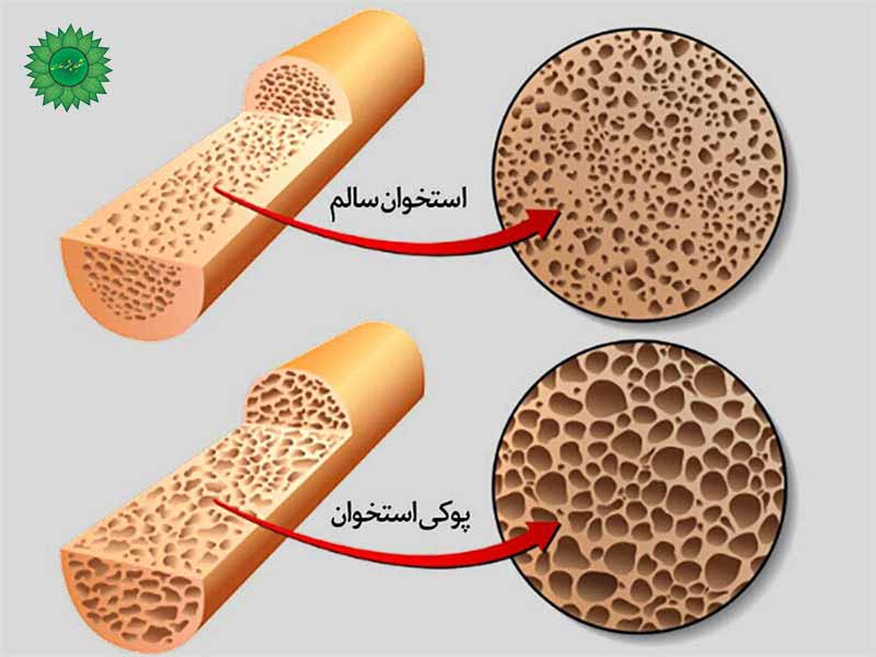 پوکی استخوان و راه های درمان خانگی