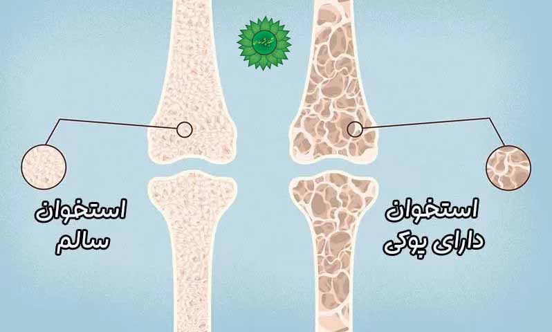 پوکی استخوان و راه های درمان خانگی