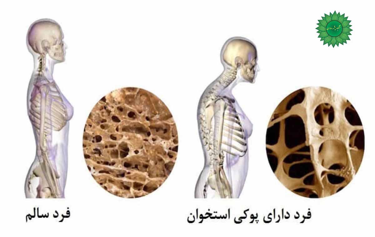 پوکی استخوان و راه های درمان خانگی