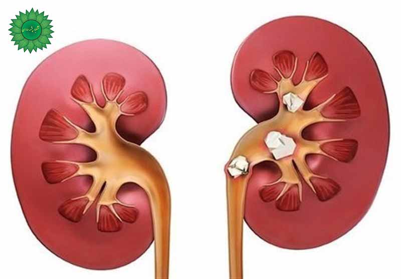 سنگ کلیه و درمان سنگ کلیه به گیاه بسر