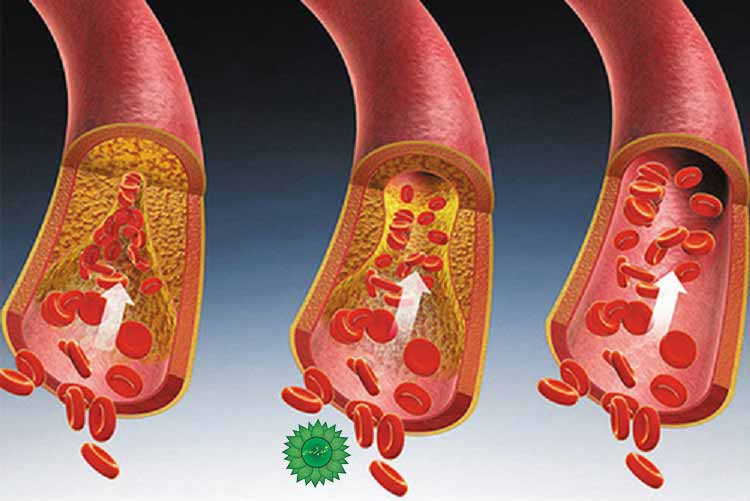 چربی خون را جدی بگیرید
