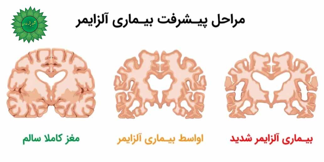 آلزایمر یک اختلال مغزی پیشرونده
